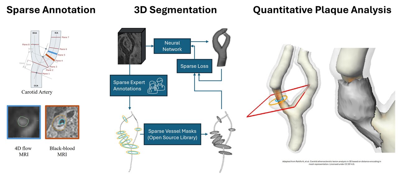 Die Abbildung zeigt drei Hauptabschnitte: "Sparse Annotation", "3D Segmentation" und "Quantitative Plaque Analysis". Jeder Abschnitt illustriert Methoden zur Analyse von Gefäßen, einschließlich MRI-Techniken und neuronalen Netzwerken zur segmentierenden Darstellung. Diagramme und Modelle verdeutlichen den Analyseprozess von Plaques.