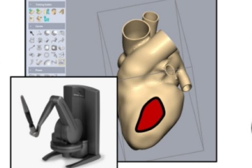 Das Bild zeigt ein 3D-Modell eines menschlichen Herzens, das in einem medizinischen Softwareprogramm dargestellt ist. Ein Teil des Herzens ist rot hervorgehoben. Neben dem Herzmodell befindet sich eine Grafik eines robotergestützten chirurgischen Instruments.