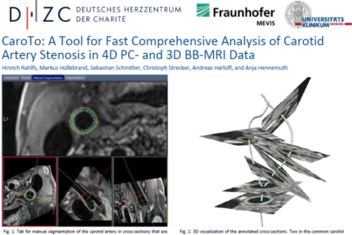 Das Bild zeigt eine Präsentation über das Tool "CaroTo", das zur Analyse von Carotisstenosen in 4D PC- und 3D BB-MRI-Daten dient. Es enthält Grafiken zur Visualisierung von Querschnitten der Halsschlagader und zur Darstellung der Gefäße im menschlichen Körper.