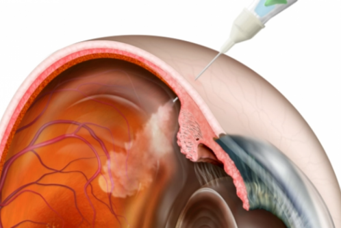 Eine schematische Darstellung eines menschlichen Auges, das eine Spritze zeigt, die in die Augenhöhle injiziert wird. Die Struktur des Auges, einschließlich Netzhaut und Blutgefäße, ist deutlich erkennbar. Die Injektion kann einem medizinischen Verfahren zur Behandlung von Augenerkrankungen zugeordnet werden.