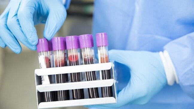 Ein medizinisches Fachpersonal trägt blaue Handschuhe und hält eine Halterung mit mehreren Reagenzgläsern. Die Gläser sind jeweils mit lila Kappen verschlossen und enthalten unterschiedliche Blutproben. Die Szene vermittelt einen Eindruck von Laborarbeit und medizinischer Analyse.